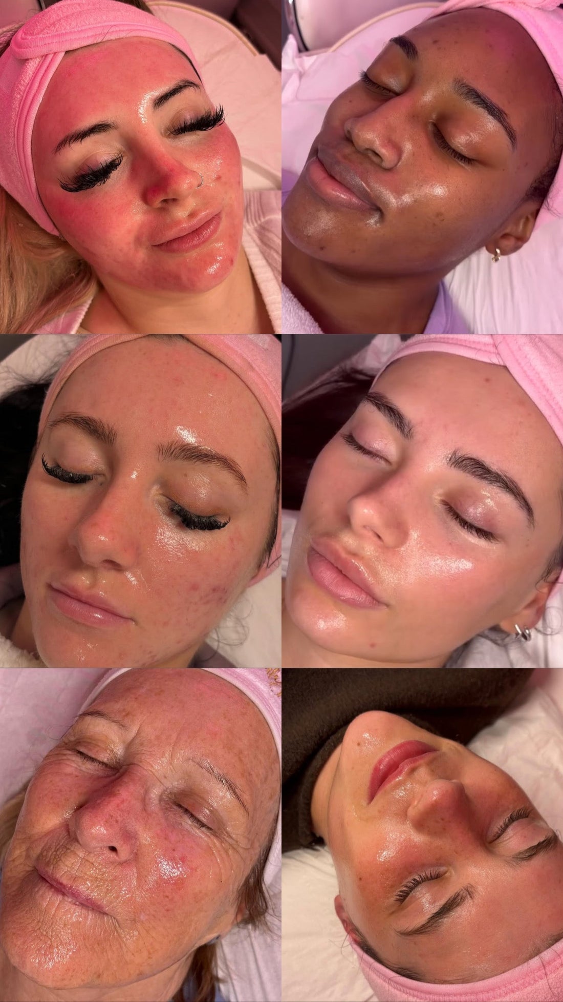 Facial Treatments